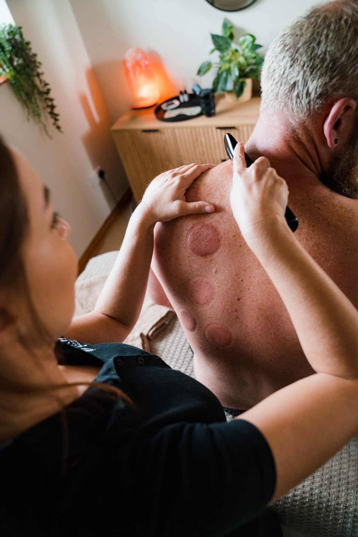 Working around cupping marks
